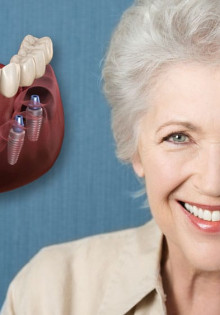 Имплантация зубов — выгодное вложение в здоровье
