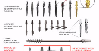 Виды имплантации зубов